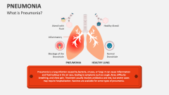 Pneumonia PowerPoint and Google Slides Template - PPT Slides