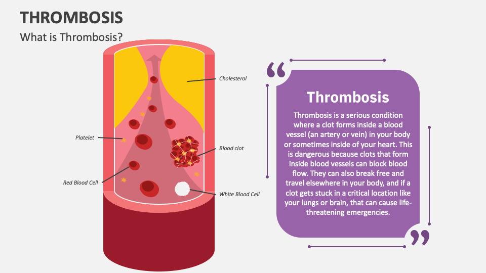 Thrombosis PowerPoint and Google Slides Template - PPT Slides