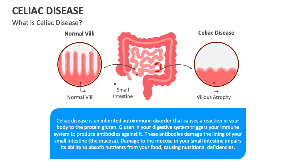 Celiac Disease PowerPoint And Google Slides Template - PPT Slides