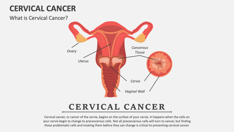 Cervical Cancer PowerPoint and Google Slides Template - PPT Slides