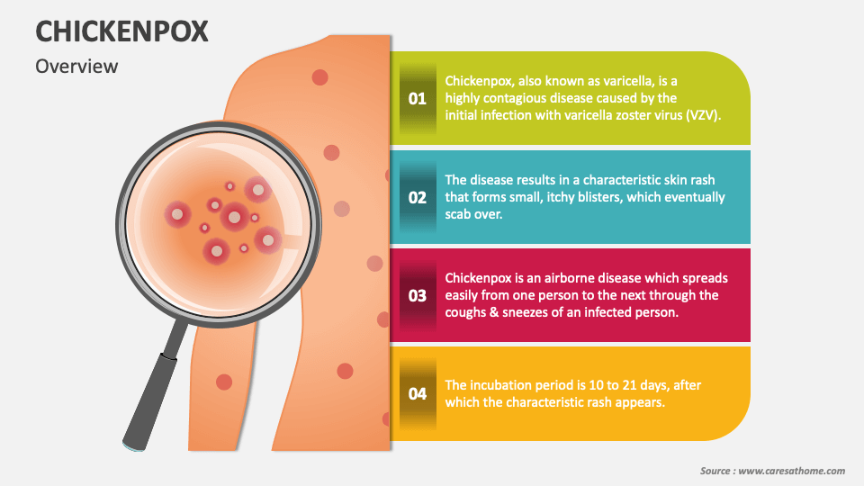 Chickenpox PowerPoint And Google Slides Template - PPT Slides