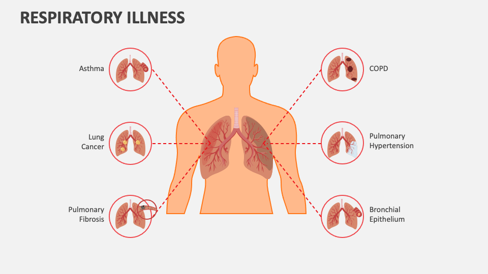 Respiratory Illness PowerPoint and Google Slides Template PPT Slides