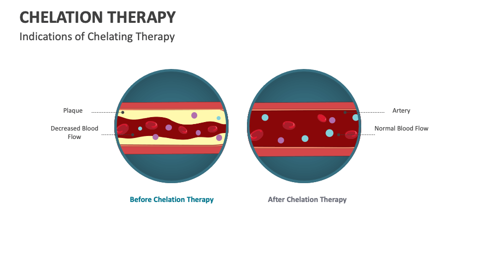 Chelation Therapy PowerPoint And Google Slides Template - PPT Slides