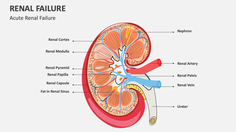 Renal Failure PowerPoint and Google Slides Template - PPT Slides