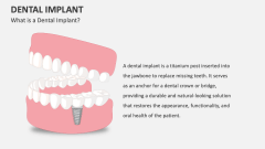 Dental Implant PowerPoint And Google Slides Template - PPT Slides