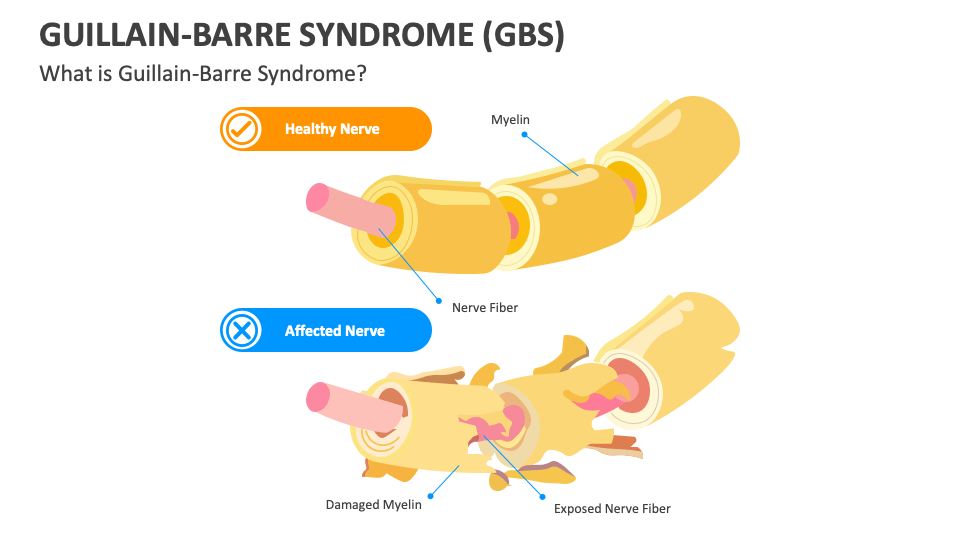 Guillain Barre Syndrome (GBS) PowerPoint And Google Slides Template ...